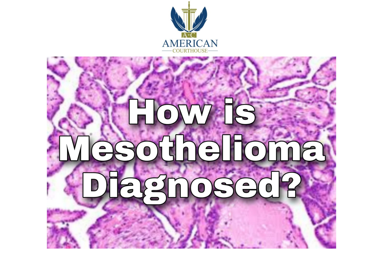 stage 1 mesothelioma symptoms